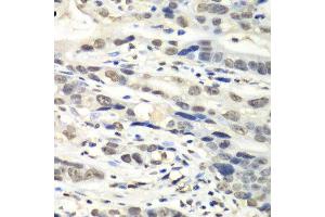 Immunohistochemistry of paraffin-embedded human gastric cancer using NUDT1 antibody. (NUDT1 抗体  (AA 1-179))