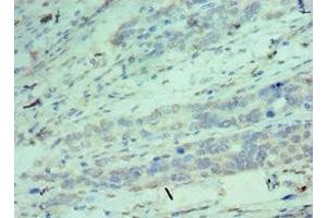 Immunohistochemistry of paraffin-embedded human endometrial cancer using ABIN7148906 at dilution of 1:100 (CDK9 抗体  (AA 153-372))