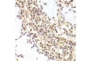 Immunohistochemistry of paraffin-embedded human adenomyosis using PHC1 antibody (ABIN5973455) at dilution of 1/200 (40x lens).