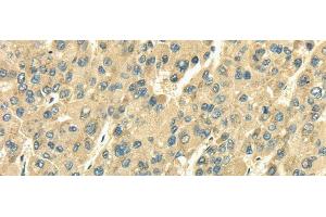 Immunohistochemistry of paraffin-embedded Human liver cancer tissue using SDF4 Polyclonal Antibody at dilution 1:35 (SDF4 抗体)