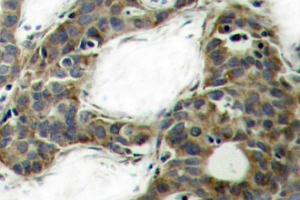 Immunohistochemistry (IHC) analyzes of Catenin-beta antibody in paraffin-embedded human breast carcinoma tissue. (CTNNB1 抗体)