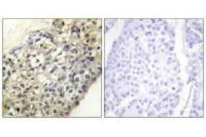 Immunohistochemistry analysis of paraffin-embedded human breast carcinoma tissue, using LATH antibody. (BPIFA4P 抗体)