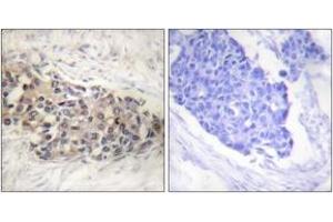 Immunohistochemistry analysis of paraffin-embedded human breast carcinoma tissue, using USF2 Antibody. (USF2 抗体  (AA 196-245))