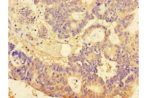 Immunohistochemistry of paraffin-embedded human colon cancer using ABIN7160076 at dilution of 1:100 (BUB3 抗体  (AA 6-217))