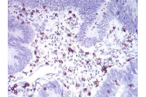 Immunohistochemical analysis of paraffin-embedded rectum cancer tissues using CD2 mouse mAb with DAB staining. (CD2 抗体  (AA 25-140))