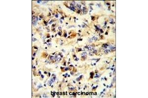 Formalin-fixed and paraffin-embedded human breast carcinoma reacted with EGFR Antibody, which was peroxidase-conjugated to the secondary antibody, followed by DAB staining. (EGFR 抗体)