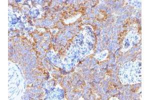 Formalin-fixed, paraffin-embedded human Colon stained with CEA Mouse Monoclonal Antibody (C66/1291). (CEACAM5 抗体)