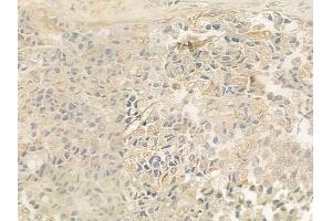 ABIN6259274 and ABIN6275418 at 1/100 staining human prostate carcinoma by IHC-P. (S100A16 抗体  (Internal Region))