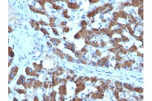 Formalin-fixed, paraffin-embedded human Hepatocellular Ca stained with CPS1 Monoclonal Antibody (SPM615). (CPS1 抗体)