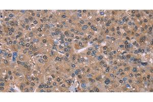 Immunohistochemistry of paraffin-embedded Human liver cancer tissue using GLYR1 Polyclonal Antibody at dilution 1:30