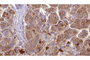 ABIN6273855 at 1/100 staining Human liver cancer tissue by IHC-P. (GPR146 抗体  (Internal Region))