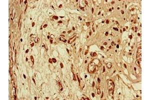 Immunohistochemistry of paraffin-embedded human lung cancer using ABIN7168651 at dilution of 1:100 (SEC14L3 抗体  (AA 201-400))
