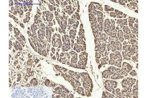Immunohistochemistry of paraffin-embedded Human stomach cancer tissue using PYCARD Polyclonal Antibody at dilution of 1:200. (PYCARD 抗体)