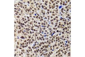 Immunohistochemistry of paraffin-embedded human kidney cancer using PHIP antibody at dilution of 1:100 (40x lens). (PHIP 抗体)