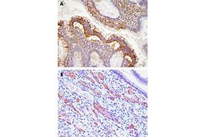 Paraffin embedded sections of human colon (A) and gastric cancer tissue (B) were incubated with EPHA2 monoclonal antibody, clone 3D7  (1:100) for 2 hours at room temperature. (EPH Receptor A2 抗体  (AA 559-976))