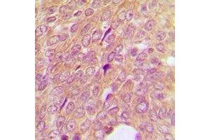 Immunohistochemical analysis of IGFBP3 staining in human breast cancer formalin fixed paraffin embedded tissue section. (IGFBP3 抗体)