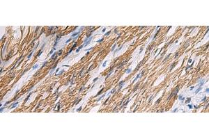 Immunohistochemistry of paraffin-embedded Human gastric cancer tissue using KCNH7 Polyclonal Antibody at dilution of 1:30(x200) (KCNH7 抗体)
