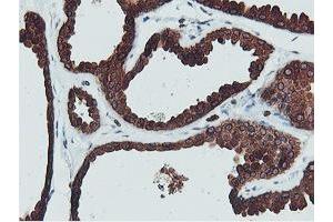 Immunohistochemical staining of paraffin-embedded Human breast tissue using anti-C20orf3 mouse monoclonal antibody. (APMAP 抗体)