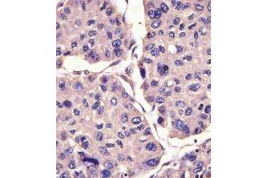 (ABIN6242256 and ABIN6578832) staining CANX in human hepatocarcinoma sections by Immunohistochemistry (IHC-P - paraformaldehyde-fixed, paraffin-embedded sections).