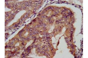 IHC image of ABIN7151045 diluted at 1:500 and staining in paraffin-embedded human endometrial cancer performed on a Leica BondTM system. (KCMF1 抗体  (AA 98-226))
