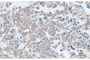 Immunohistochemistry of paraffin-embedded Human lung cancer using ZNF581 Polyclonal Antibody at dilution of 1:100 (40x lens). (ZNF581 抗体)