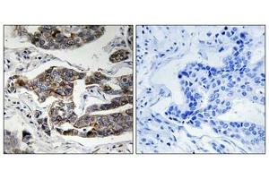 Immunohistochemical analysis of paraffin-embedded human breast carcinoma tissue using Girdin (Phospho-Ser1417) antibody (left)or the same antibody preincubated with blocking peptide (right). (Girdin 抗体  (pSer417))