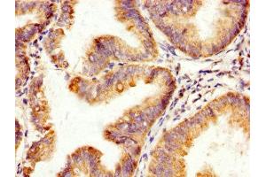 IHC image of ABIN7170472 diluted at 1:200 and staining in paraffin-embedded human endometrial cancer performed on a Leica BondTM system. (SPA17 抗体  (AA 1-146))