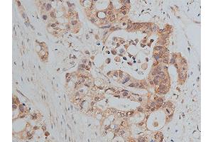 ABIN6266511 at 1/50 staining human colon cancer tissue sections by IHC-P. (E-cadherin 抗体  (C-Term))