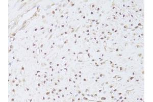 Immunohistochemistry of paraffin-embedded human leiomyoma of uterus using FKBP4 Antibody (ABIN5973289) at dilution of 1/100 (40x lens). (FKBP4 抗体)