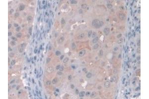 Detection of GAMT in Human Breast cancer Tissue using Polyclonal Antibody to Guanidinoacetate-N-Methyltransferase (GAMT) (GAMT 抗体  (AA 64-236))