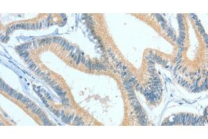 Immunohistochemistry of paraffin-embedded Human colon cancer using ASGR1 Polyclonal Antibody at dilution of 1:50 (Asialoglycoprotein Receptor 1 抗体)