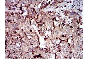Immunohistochemical analysis of paraffin-embedded liver cancer tissues using PLA2G12A mouse mAb with DAB staining. (PLA2G12A 抗体  (AA 21-189))