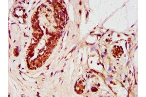 IHC image of ABIN7176505 diluted at 1:400 and staining in paraffin-embedded human breast cancer performed on a Leica BondTM system. (ZNF73 抗体  (AA 218-286))