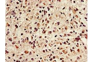 Immunohistochemistry of paraffin-embedded human glioma using ABIN7151635 at dilution of 1:100 (Nth Endonuclease III-Like 1 (NTHL1) (AA 31-312) 抗体)
