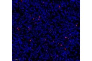 Immunofluorescence of paraffin embedded human colon cancer using c-caspase3 (ABIN7073336) at dilution of 1:500 (200x lens) (Caspase 3 抗体  (cleaved))