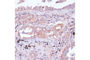Immunohistochemistry of paraffin-embedded human lung cancer using RPL32 antibody (ABIN6129104, ABIN6147138, ABIN6147139 and ABIN6216824) at dilution of 1:100 (40x lens). (RPL32 抗体  (AA 1-135))