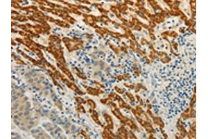 The image on the left is immunohistochemistry of paraffin-embedded Human liver cancer tissue using ABIN7190314(CMTM7 Antibody) at dilution 1/30, on the right is treated with synthetic peptide. (CMTM7 抗体)