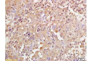 Formalin-fixed and paraffin embedded human breast carcinoma labeled with Rabbit Anti Phospho-BRCA1(Ser1189) Polyclonal Antibody, Unconjugated (ABIN756637) at 1:200 followed by conjugation to the secondary antibody and DAB staining (BRCA1 抗体  (pSer1189))