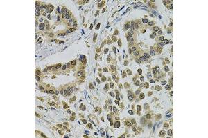 Immunohistochemistry of paraffin-embedded human breast cancer using EBAG9 Antibody. (RCAS1 抗体  (AA 28-213))