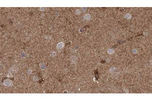 ABIN6277796 at 1/100 staining Human brain cancer tissue by IHC-P. (CLCN3 抗体  (N-Term))