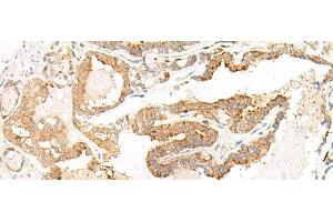 Immunohistochemistry of paraffin-embedded Human thyroid cancer tissue using HEBP1 Polyclonal Antibody at dilution of 1:60(x200) (HEBP1 抗体)