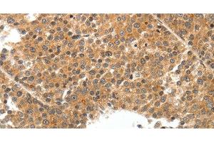 Immunohistochemistry of paraffin-embedded Human liver cancer tissue using TEK Polyclonal Antibody at dilution 1:50 (TEK 抗体)