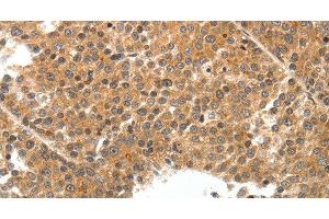 Immunohistochemistry of paraffin-embedded Human liver cancer tissue using TEK Polyclonal Antibody at dilution 1:50