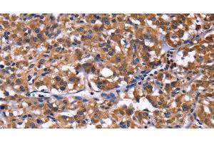 Immunohistochemistry of paraffin-embedded Human thyroid cancer tissue using SELPLG Polyclonal Antibody at dilution 1:50 (SELPLG 抗体)