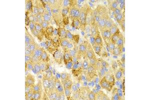 Immunohistochemistry of paraffin-embedded human liver cancer using LAMP3 antibody (ABIN5971497) at dilution of 1/100 (40x lens). (LAMP3 抗体)