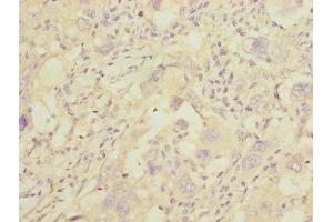 Immunohistochemistry of paraffin-embedded human liver cancer using ABIN7154068 at dilution of 1:100 (GGTLC2 抗体  (AA 1-218))