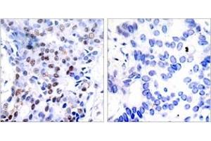 Immunohistochemistry analysis of paraffin-embedded human breast carcinoma tissue, using c-Jun (Ab-91) Antibody.