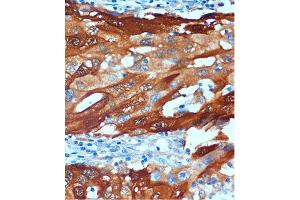 Immunohistochemistry of paraffin-embedded Human breast cancer using Secretagogin (Secretagogin (SCGN)) Rabbit pAb (ABIN6130685, ABIN6147431, ABIN6147432 and ABIN6216698) at dilution of 1:100 (40x lens). (SCGN 抗体  (AA 1-276))