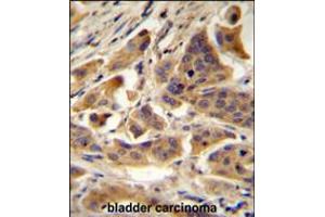 RBCK1 (UBCE7IP3) Antibody immunohistochemistry analysis in formalin fixed and paraffin embedded human bladder carcinoma followed by peroxidase conjugation of the secondary antibody and DAB staining. (RBCK1 抗体  (N-Term))