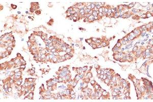 Immunohistochemistry of paraffin-embedded Human thyroid cancer using FRMD6 Polyclonal Antibody at dilution of 1:100 (40x lens). (FRMD6 抗体)